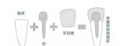 牙医让戴牙冠，真的是为你的牙齿着想！—义乌傅氏口腔