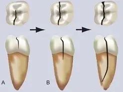 牙医让戴牙冠，真的是为你的牙齿着想！—义乌傅氏口腔