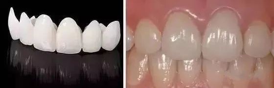 牙医让戴牙冠，真的是为你的牙齿着想！—义乌傅氏口腔