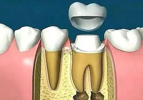 牙医让戴牙冠，真的是为你的牙齿着想！—义乌傅氏口腔