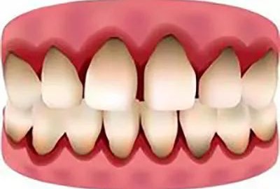 可怕的就是牙龈萎缩! 可怕的就是牙龈萎缩!