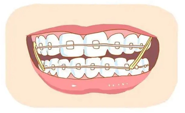 正畸会导致牙齿变松？