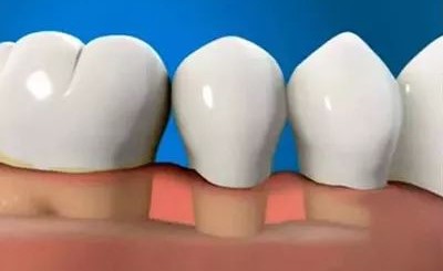 可怕的就是牙龈萎缩! 可怕的就是牙龈萎缩!