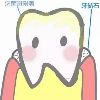 是牙结石一步步侵入了你的牙齿!—义乌傅氏口腔 是牙结石一步步侵入了你的牙齿!—义乌傅氏口腔