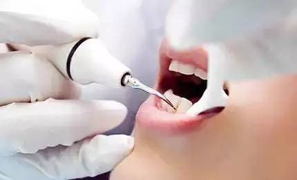 是牙结石一步步侵入了你的牙齿!—义乌傅氏口腔 是牙结石一步步侵入了你的牙齿!—义乌傅氏口腔