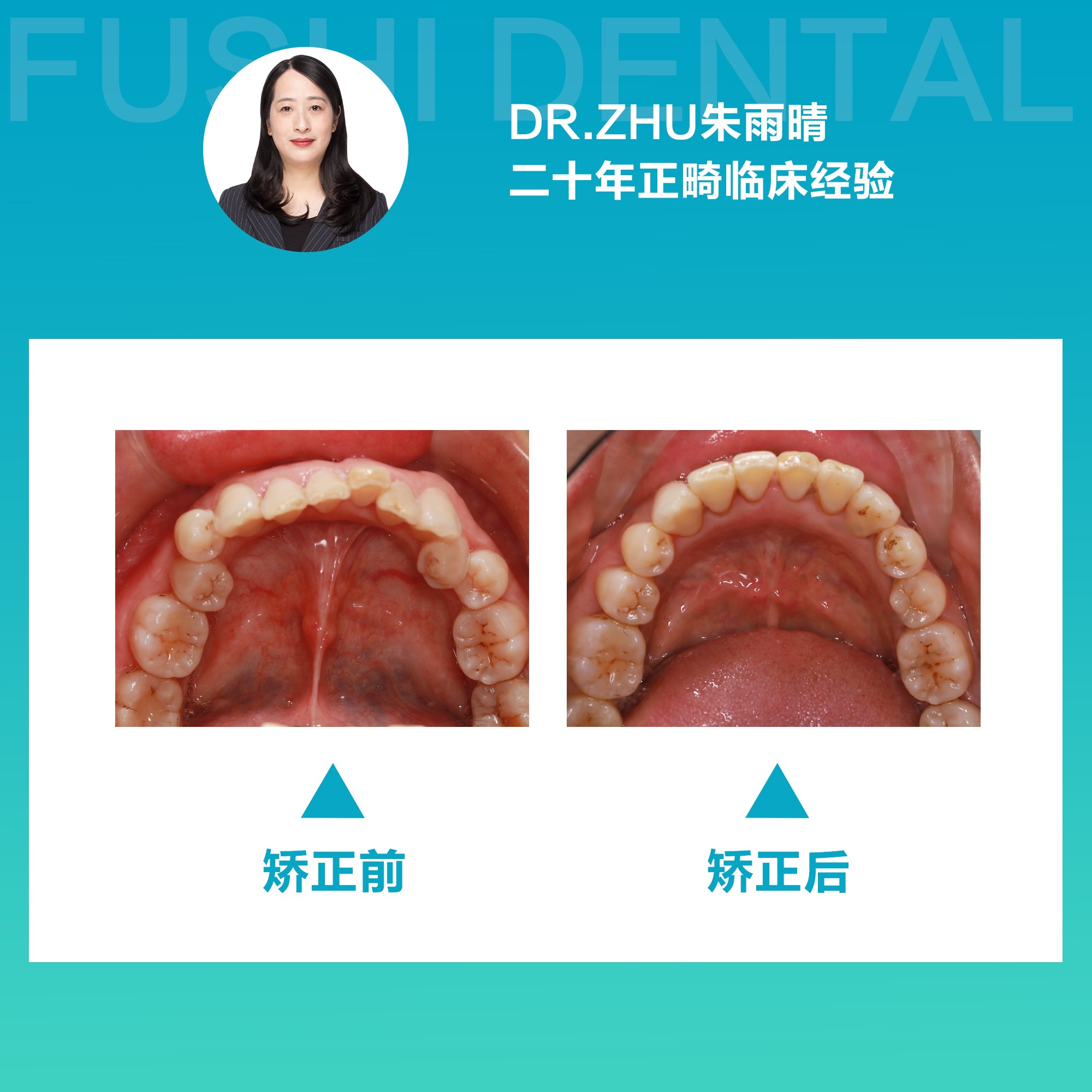 女士牙齿内倾型深覆颌、牙列拥挤矫正—义乌傅氏口腔