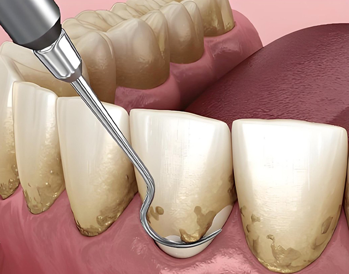 牙周刮治完可以立即种植牙么?—义乌口腔种植 牙周刮治完可以立即种植牙么?—义乌口腔种植