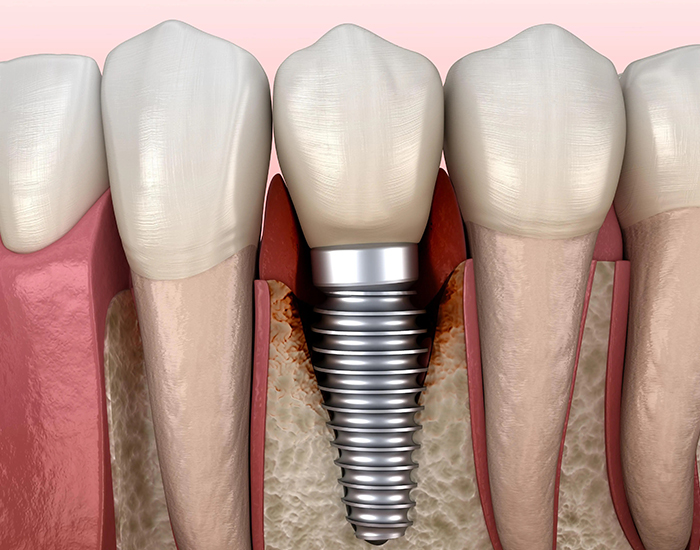 牙周刮治完可以立即种植牙么?—义乌口腔种植 牙周刮治完可以立即种植牙么?—义乌口腔种植