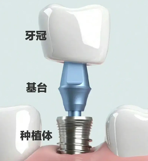 牙周刮治完可以立即种植牙么?—义乌口腔种植 牙周刮治完可以立即种植牙么?—义乌口腔种植