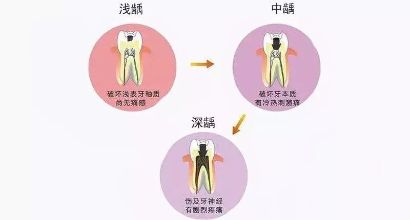 什么是牙髓炎,牙髓炎可以自愈吗? 什么是牙髓炎,牙髓炎可以自愈吗?