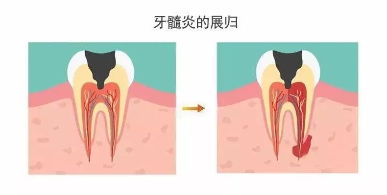 什么是牙髓炎,牙髓炎可以自愈吗? 什么是牙髓炎,牙髓炎可以自愈吗?