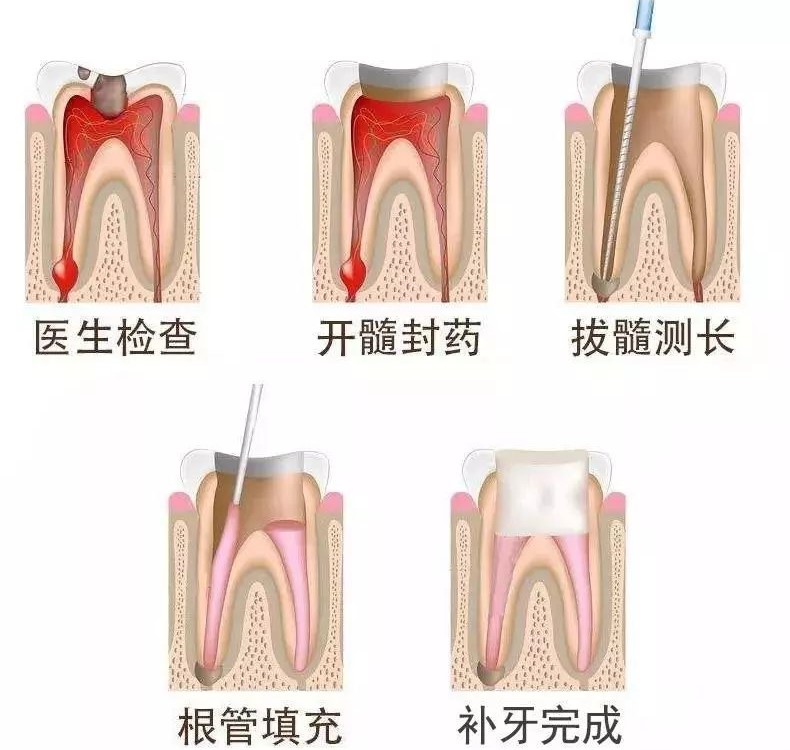 什么是牙髓炎,牙髓炎可以自愈吗? 什么是牙髓炎,牙髓炎可以自愈吗?