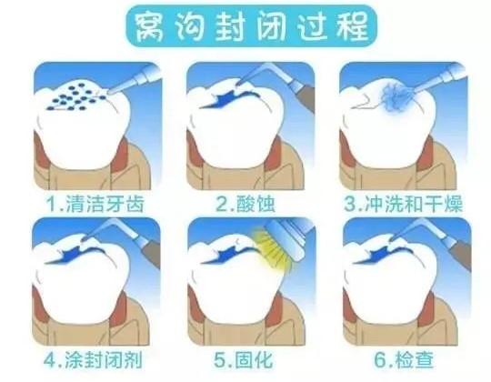 六成儿童蛀牙都发生在这颗牙上！