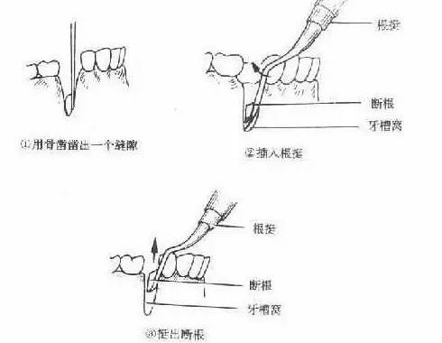 口腔常用的牙挺种类及使用! 口腔常用的牙挺种类及使用!
