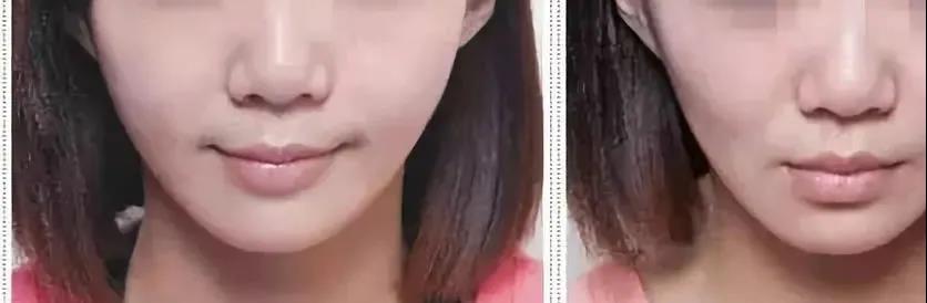 矫正前vs矫正后，传说中的牙套脸