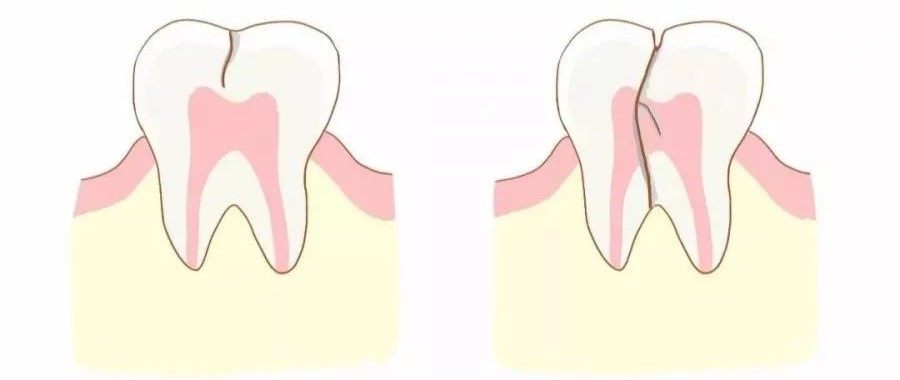 牙痛的真相，疼的明明白白！—义乌傅氏口腔