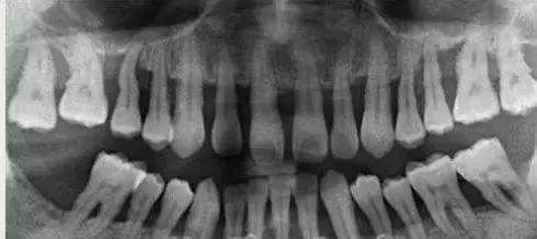 牙龈炎与牙周炎有何区别？—义乌傅氏口腔