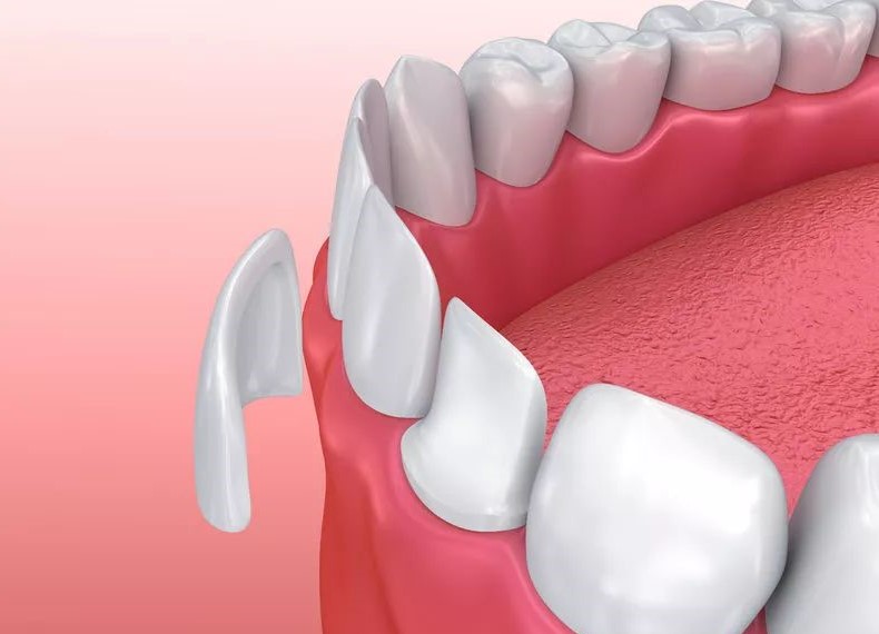 娱乐圈的“接班人”用什么方式整牙?—义乌傅氏口腔 娱乐圈的“接班人”用什么方式整牙?—义乌傅氏口腔