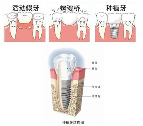 口腔种植牙详细介绍！