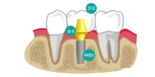 口腔种植牙详细介绍！