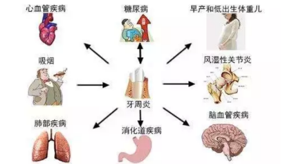 牙周病及全身系统疾病关系 牙周病及全身系统疾病关系