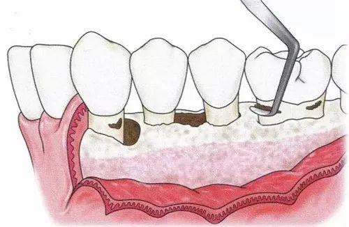 牙周治疗就像踩刹车—义乌傅氏口腔