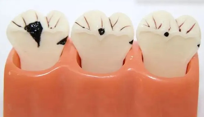 夜间突发牙疼当心牙髓炎! 夜间突发牙疼当心牙髓炎!