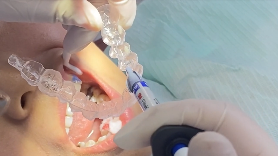 你如果也这样困扰，隐形牙套了解一下！—义乌傅氏口腔