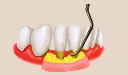 为何牙结石会长在牙龈下面? 为何牙结石会长在牙龈下面?