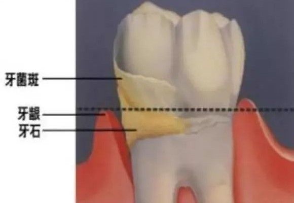 为何牙结石会长在牙龈下面? 为何牙结石会长在牙龈下面?