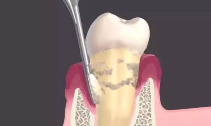为何牙结石会长在牙龈下面? 为何牙结石会长在牙龈下面?