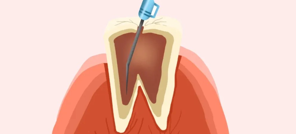 根管治疗容易出现的问题！