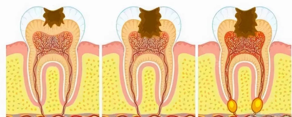 根管治疗容易出现的问题！