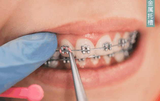 关于牙齿矫正的诸多疑问! 关于牙齿矫正的诸多疑问!