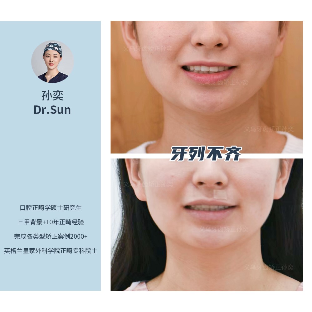 义乌傅氏口腔牙列拥挤不齐矫正案例分享！