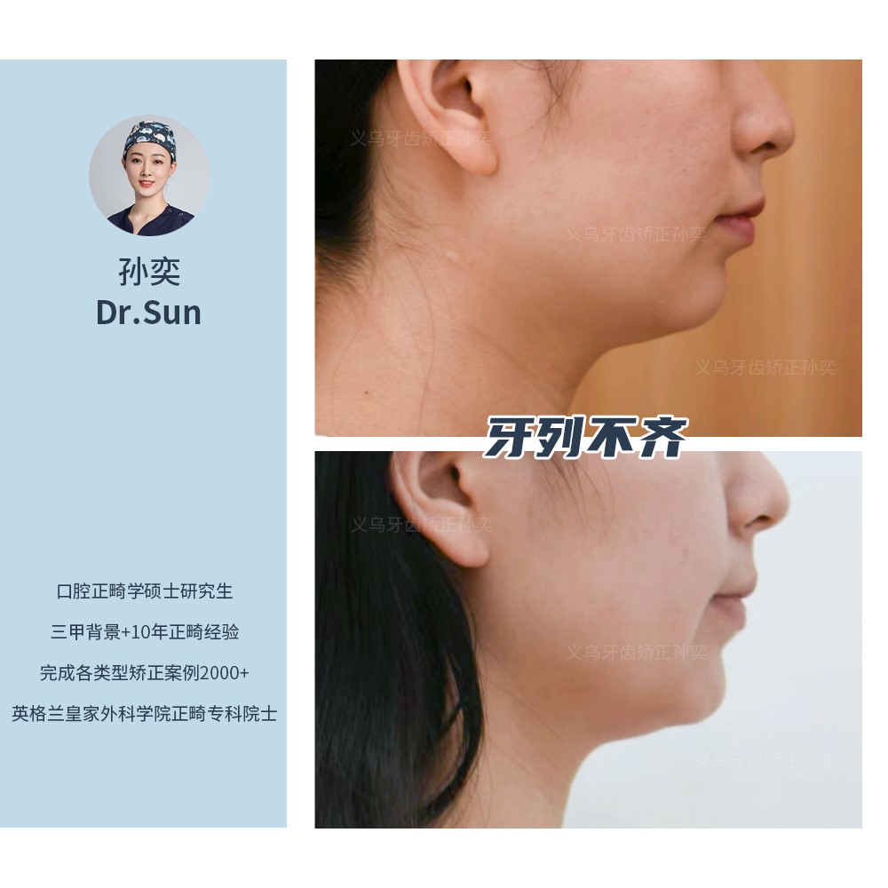 义乌傅氏口腔牙列拥挤不齐矫正案例分享！