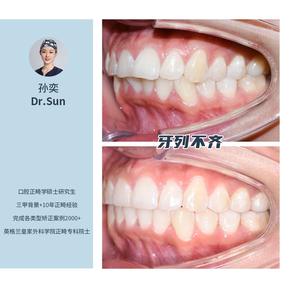 义乌傅氏口腔牙列拥挤不齐矫正案例分享！