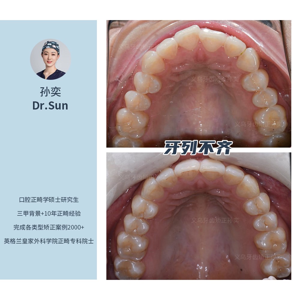 义乌傅氏口腔牙列拥挤不齐矫正案例分享！