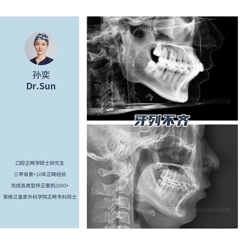 义乌傅氏口腔牙列拥挤不齐矫正案例分享！