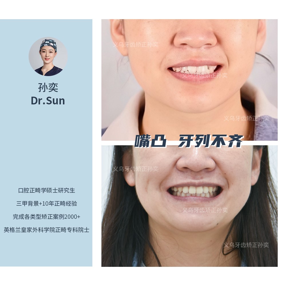 义乌傅氏口腔嘴凸牙列不齐矫正案例分享！