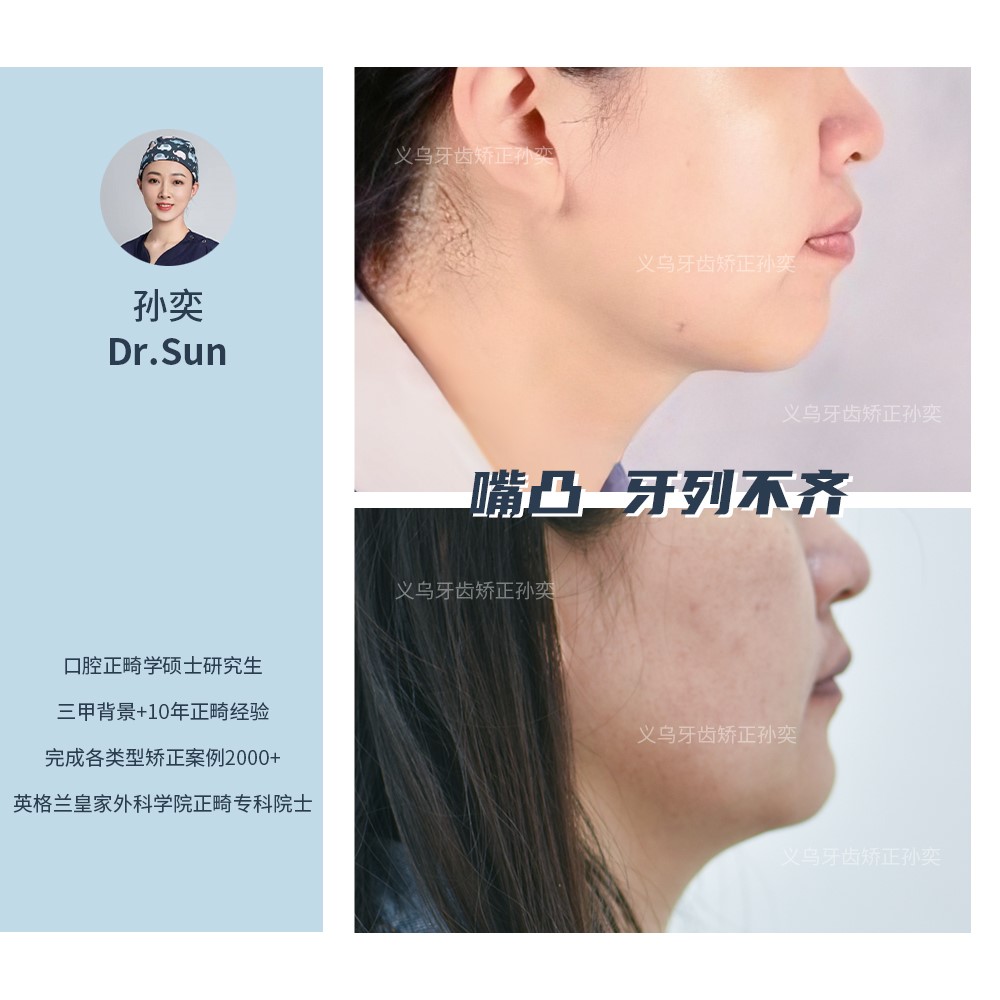 义乌傅氏口腔嘴凸牙列不齐矫正案例分享！