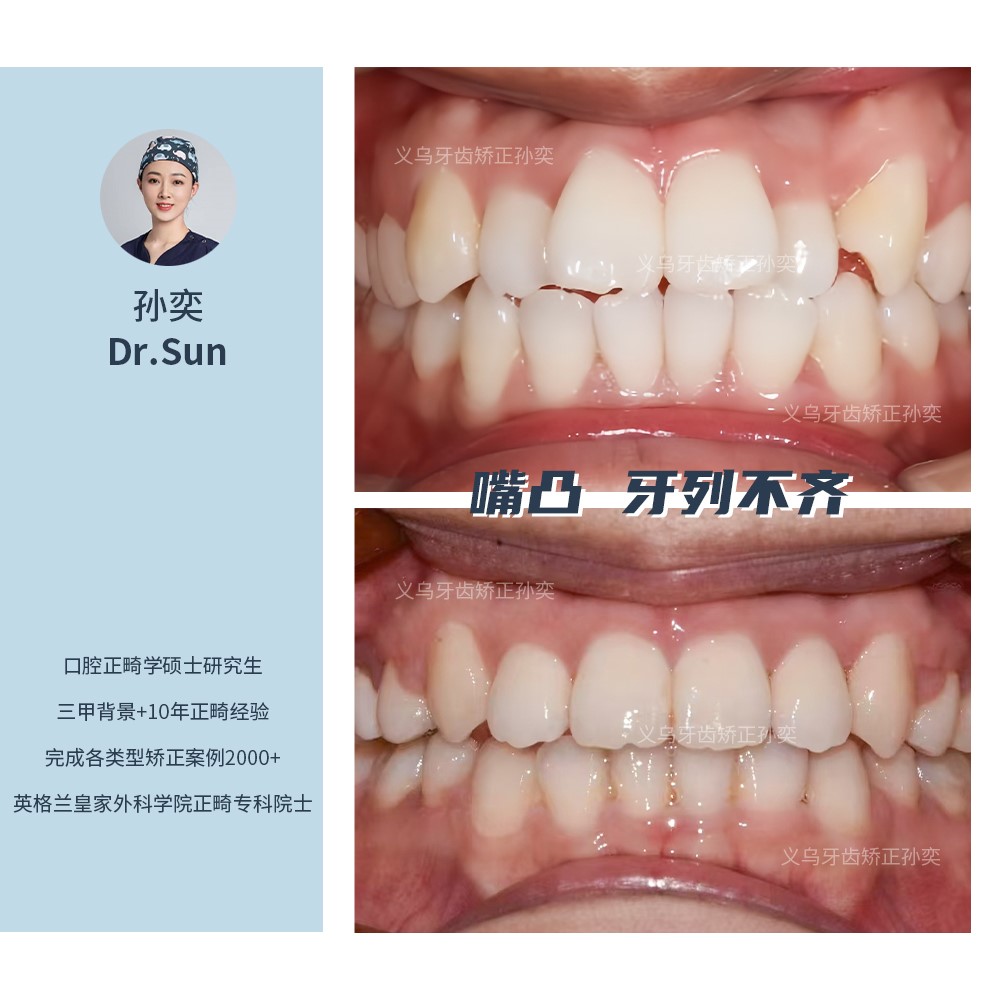 义乌傅氏口腔嘴凸牙列不齐矫正案例分享！