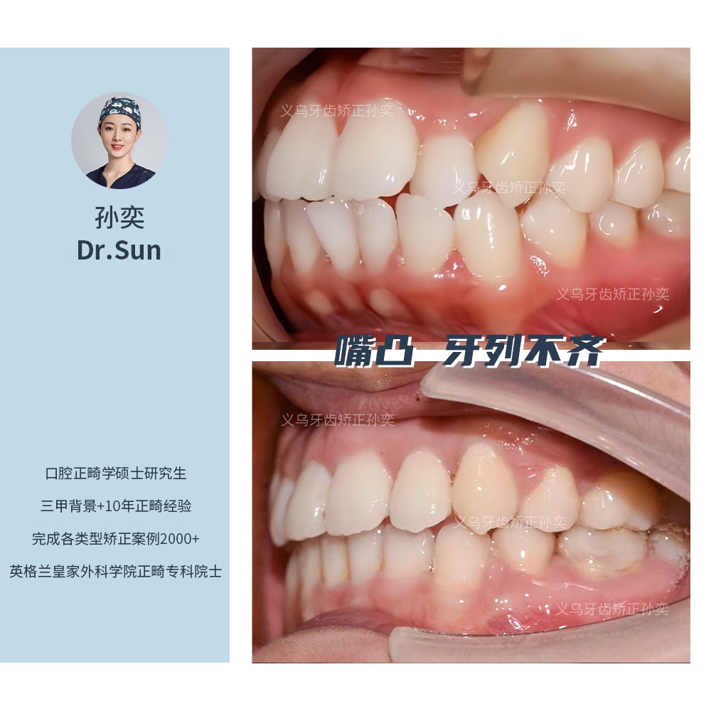 义乌傅氏口腔嘴凸牙列不齐矫正案例分享！