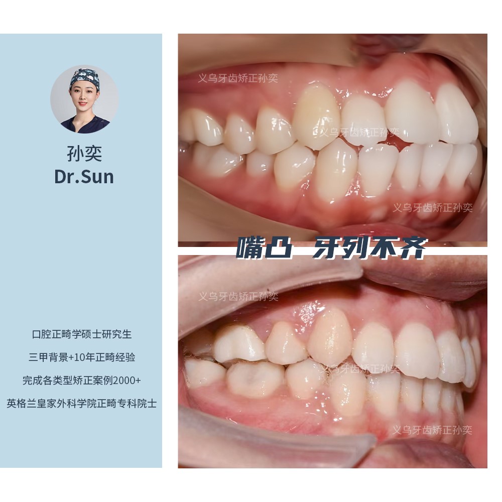 义乌傅氏口腔嘴凸牙列不齐矫正案例分享！
