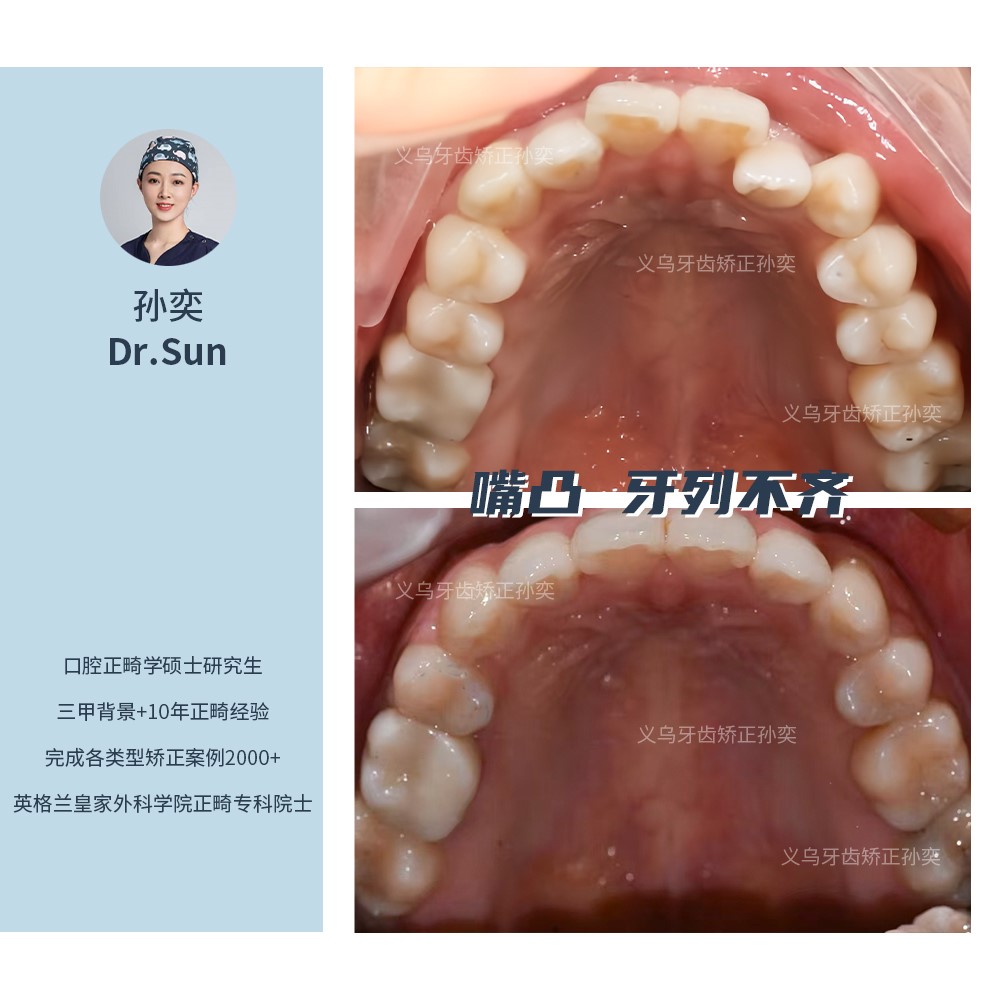 义乌傅氏口腔嘴凸牙列不齐矫正案例分享！