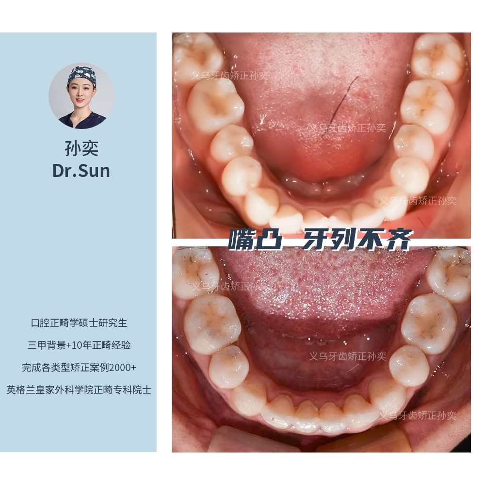 义乌傅氏口腔嘴凸牙列不齐矫正案例分享！