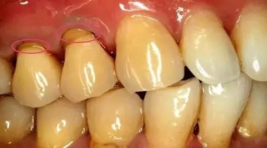 医生,牙齿为何越来越长? 医生,牙齿为何越来越长?