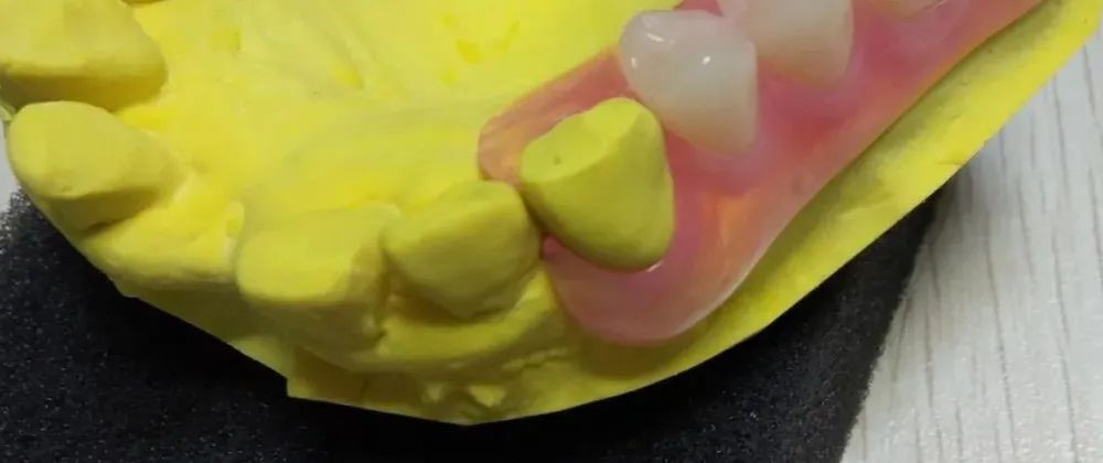 怎么解决活动义齿压痛问题？