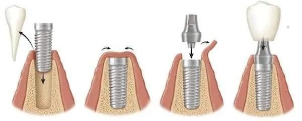 口腔种植牙详细介绍,患者再问用它! 口腔种植牙详细介绍,患者再问用它!