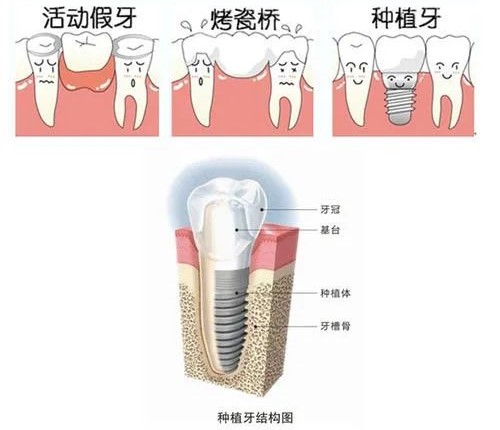 口腔种植牙详细介绍,患者再问用它! 口腔种植牙详细介绍,患者再问用它!